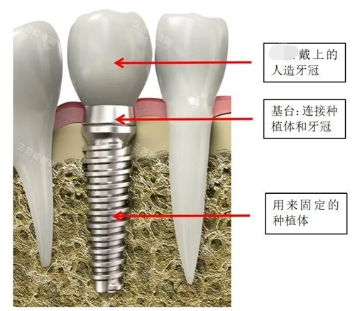 深圳尚佳口腔做種植牙究竟幾多錢？有冇詳細價格表？種牙收費包晒所有工序？求真相！
