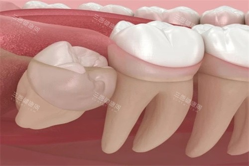 智齿朝外长 智齿朝外长