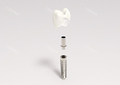 种植牙图片 种植牙图片