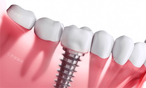 裝活動假牙和種植牙哪個痛苦？分享兩者原理特點和使用體驗別錯過！