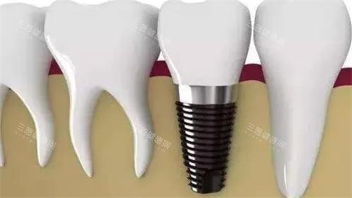 种植牙后<span style= 种植牙后<span style=