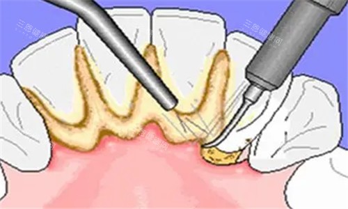 洗牙结石照片 洗牙结石照片