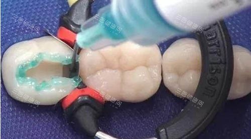 儿童补牙材料 儿童补牙材料