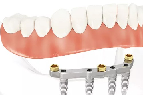 半口种植牙联排牙冠示意图 半口种植牙联排牙冠示意图