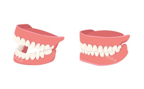 假牙示意图 假牙示意图
