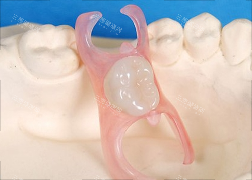 单颗活动假牙展示图 单颗活动假牙展示图