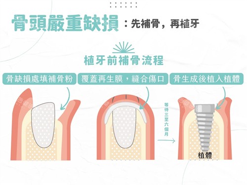 种植牙植骨与植体植入过程漫画图 种植牙植骨与植体植入过程漫画图