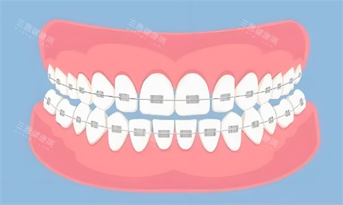 金属矫正牙齿 金属矫正牙齿