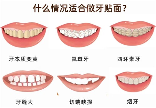 香港貼面修復幾錢，貼面修復的類型及價格差異查看！