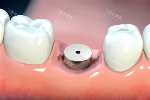 韓一種植牙到底值不值？對比傳統假牙後，我完全被它的舒適度征服了！