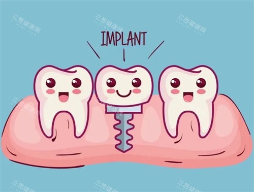 种植牙漫画示意图 种植牙漫画示意图