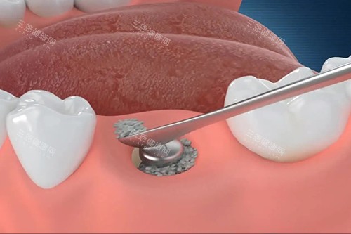 韓一種植牙適合老年人嗎？帶60歲老媽做完，她現在啃排骨比我還猛！