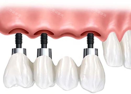 种植牙固定桥修复体 种植牙固定桥修复体