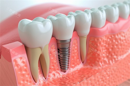 分享阿妈在香港種牙的親身經歷，怪不得咁多人都選擇去深圳種牙，深圳價格和體驗感真的太香了