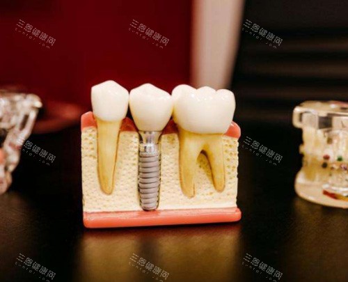 种植牙模具图 种植牙模具图