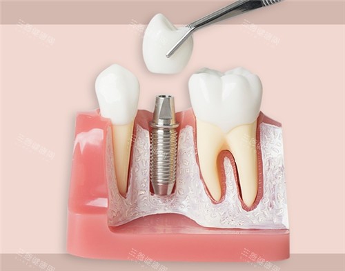 周凌醫生種牙技術點樣呀？5年完成5000+種牙病例，成功幾率96.7%！坐診醫院同預約攻略分享