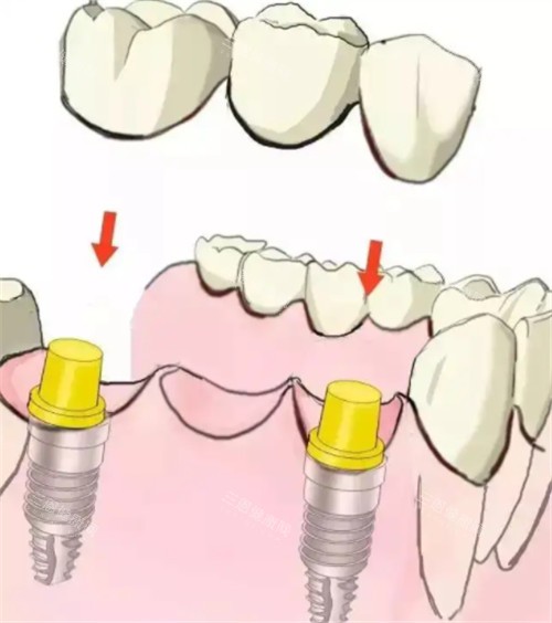 深圳華誠博雅口腔種植牙咋樣？種牙收費公道，優勢滿滿超值得試！