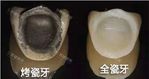 香港烤瓷牙價格是多少？分享烤瓷冠和全瓷冠特點以及費用明細！