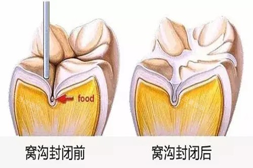 牙齿窝沟封闭前后对比卡通示意图