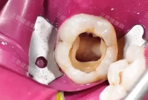 牙齿根管治疗图片 牙齿根管治疗图片