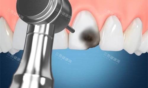 牙齿修复操作卡通图 牙齿修复操作卡通图
