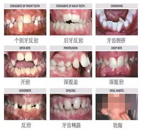 牙齿矫正不同类型的适应症 牙齿矫正不同类型的适应症