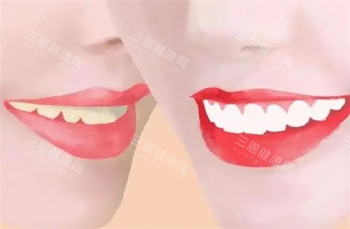 牙齿美白前后对比图 牙齿美白前后对比图