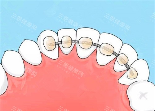 牙齿矫正舌侧保持器 牙齿矫正舌侧保持器
