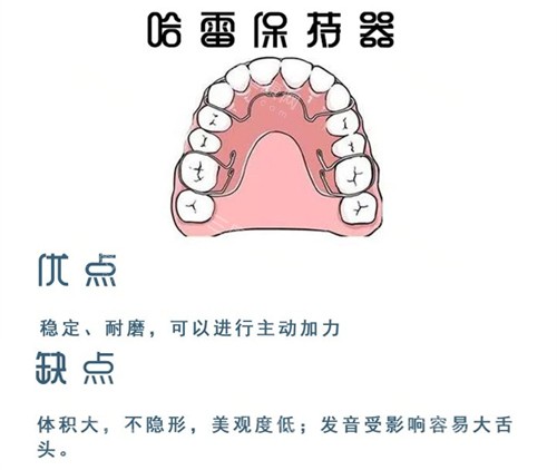 牙齿矫正哈雷保持器 牙齿矫正哈雷保持器