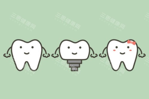 单颗种植牙卡通展示图