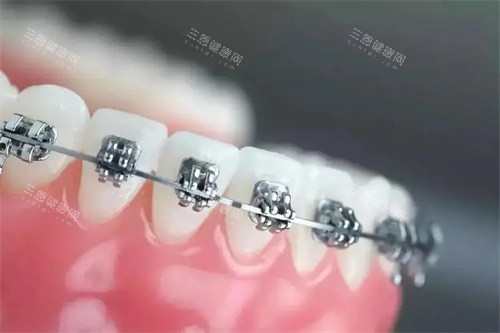 金属自锁托槽矫正 金属自锁托槽矫正