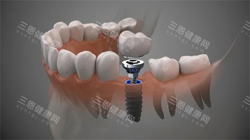 深圳元亨口腔種植牙價格表超清晰！做種植牙多少錢、種牙收費一眼睇晒，唔使驚畀人「劏」