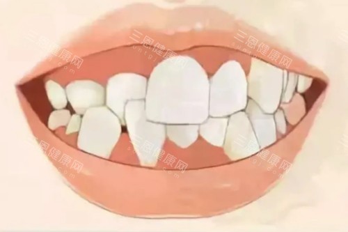 牙齿畸形卡通模型图 牙齿畸形卡通模型图