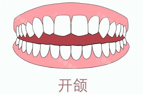 牙齿开颌 牙齿开颌
