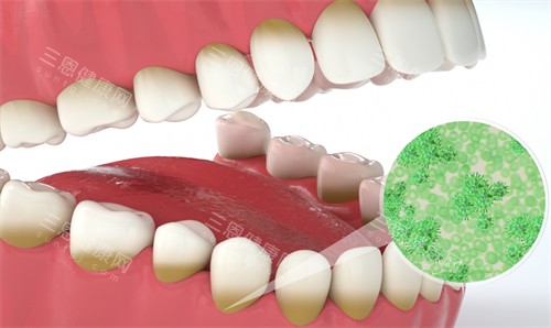 牙齿上会存在的细菌 牙齿上会存在的细菌
