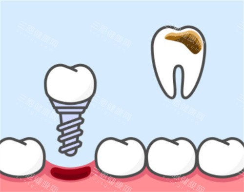 牙齿坏了换种植牙