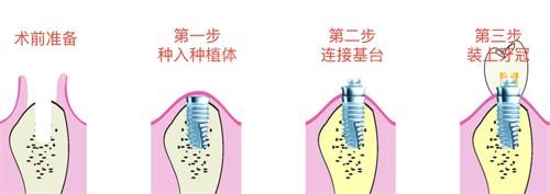 种植牙的步骤