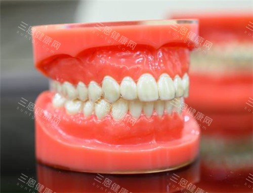 隐形矫正牙套佩戴模型展示图