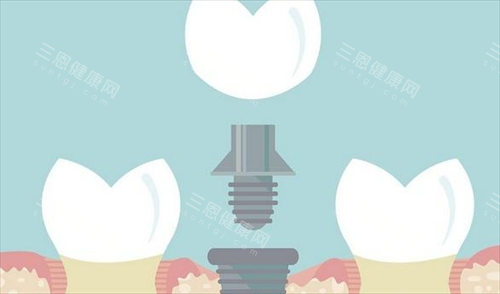 深圳种牙价格系香港几多？2025攻略：港人点样预约？点样拣诊所？附各类型种植牙价格参考！