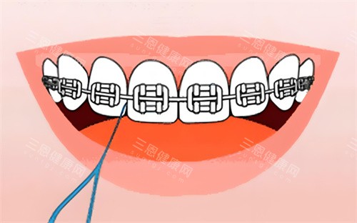 金属牙齿矫正卡通图片