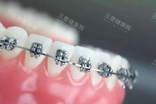 牙齿矫正牙套金属托槽矫正 牙齿矫正牙套金属托槽矫正