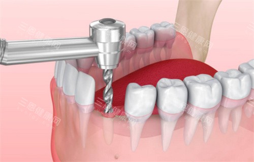 种植牙过程动画展示 种植牙过程动画展示