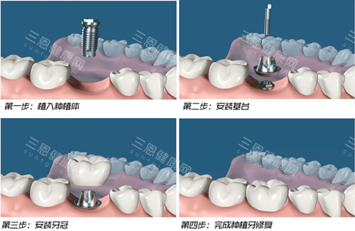 种植牙过程图示 种植牙过程图示