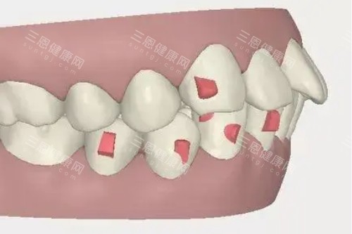 牙齿突出卡通图 牙齿突出卡通图