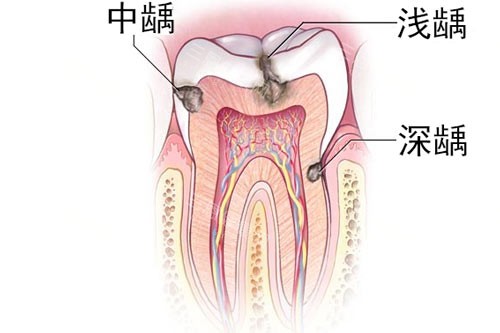 牙齿龋齿深浅图 牙齿龋齿深浅图