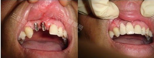 种牙前后照片 种牙前后照片