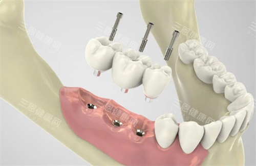 种植牙过程展示图片 种植牙过程展示图片