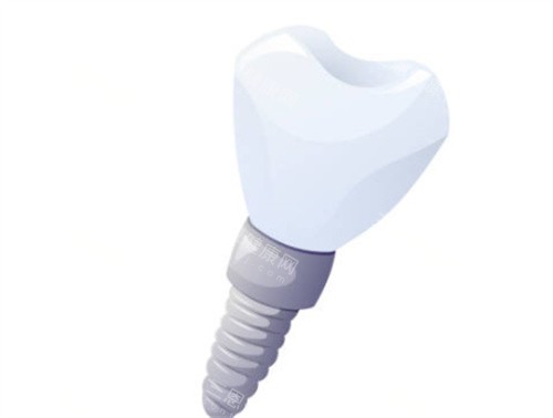 种植牙斜度图 种植牙斜度图