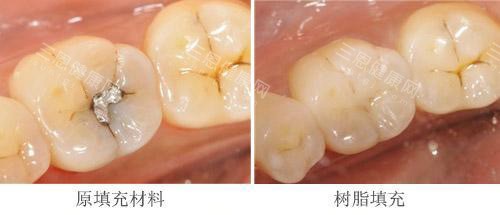 补牙材料不同示意图