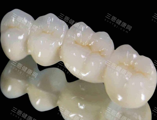 钯金烤瓷牙模型